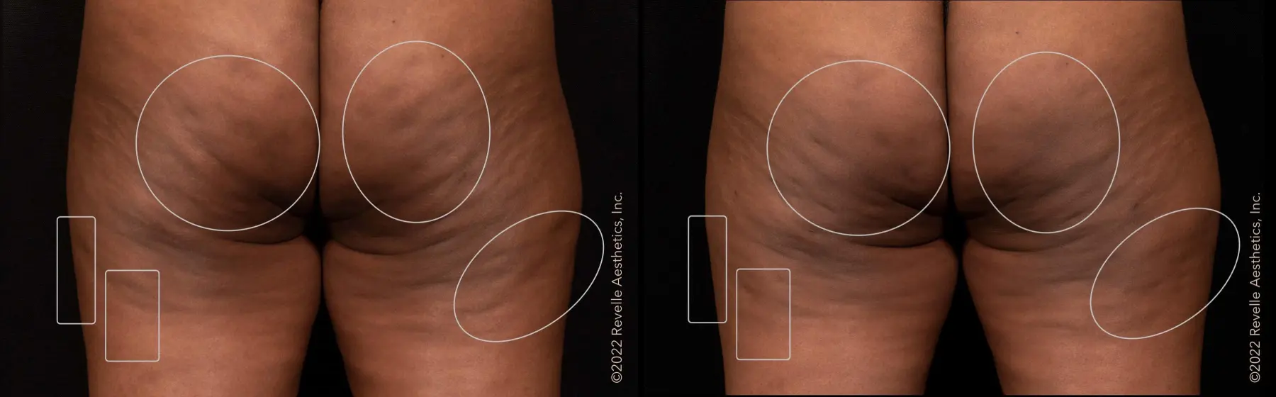 Aveli: Patient 2 - Before and After  