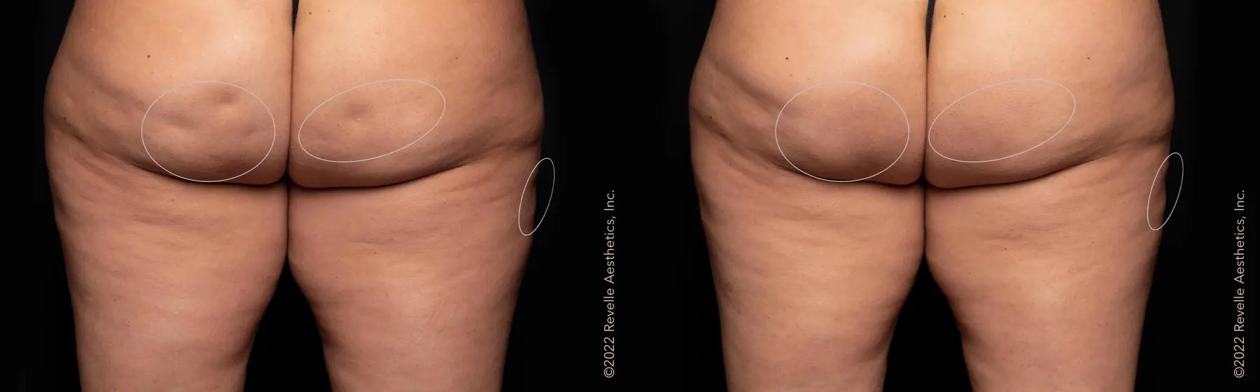 Aveli: Patient 9 - Before and After  