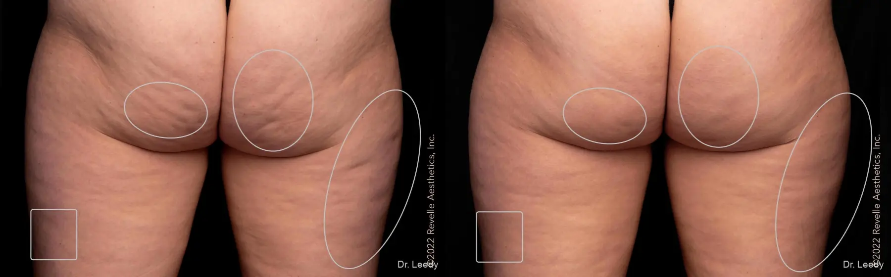 Aveli: Patient 3 - Before and After  