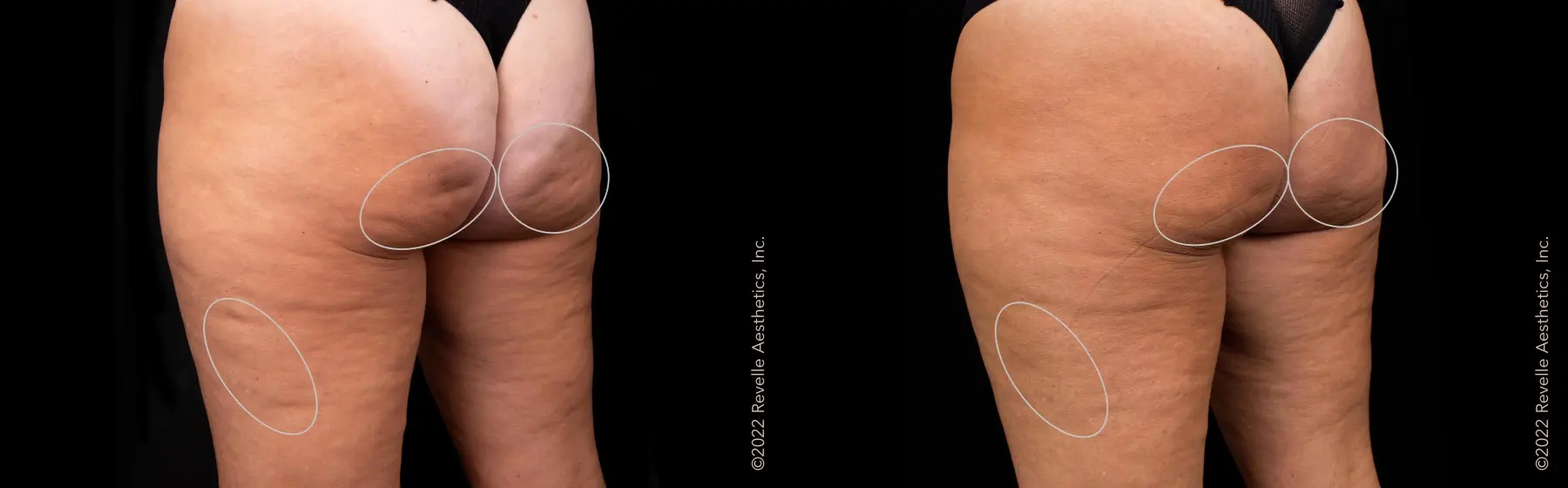 Aveli: Patient 23 - Before and After  
