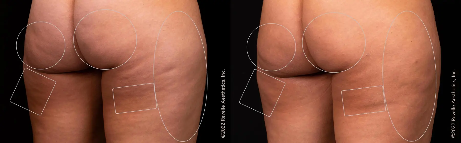 Aveli: Patient 1 - Before and After  