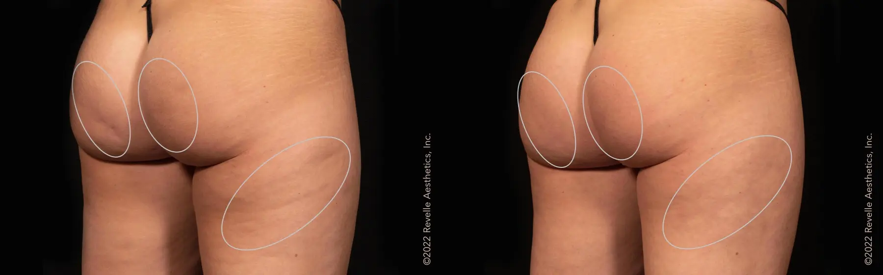 Aveli: Patient 13 - Before and After  