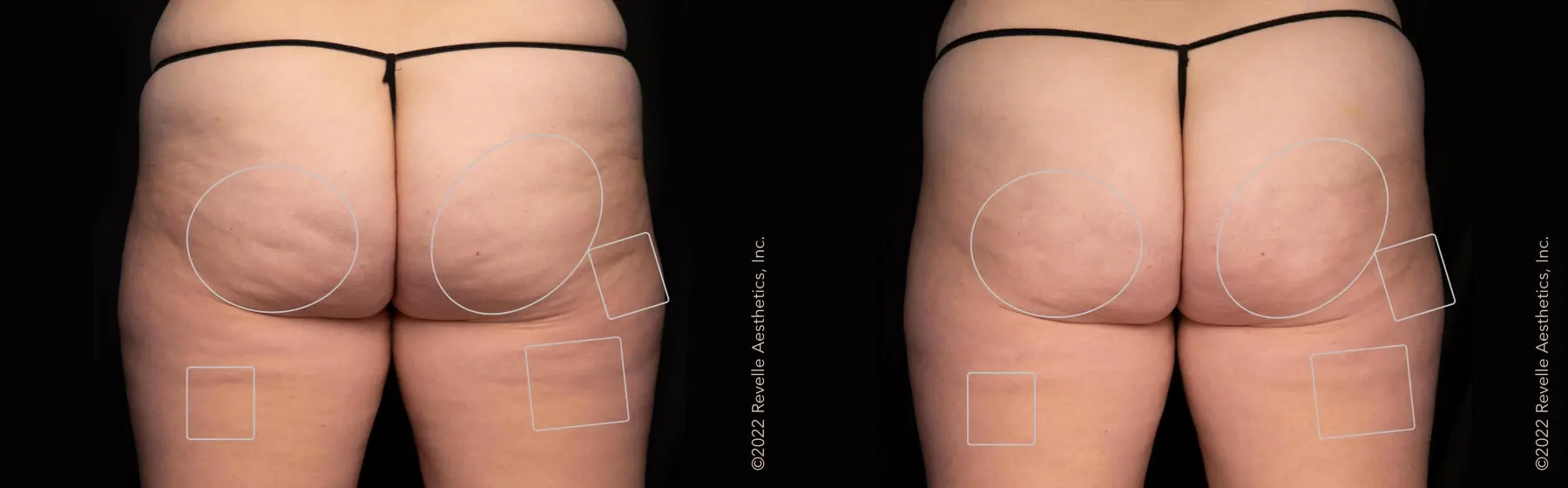 Aveli: Patient 18 - Before and After  