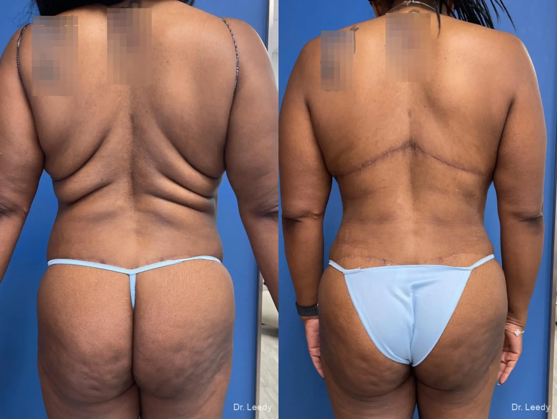 Back Lift: Patient 1 - Before and After  