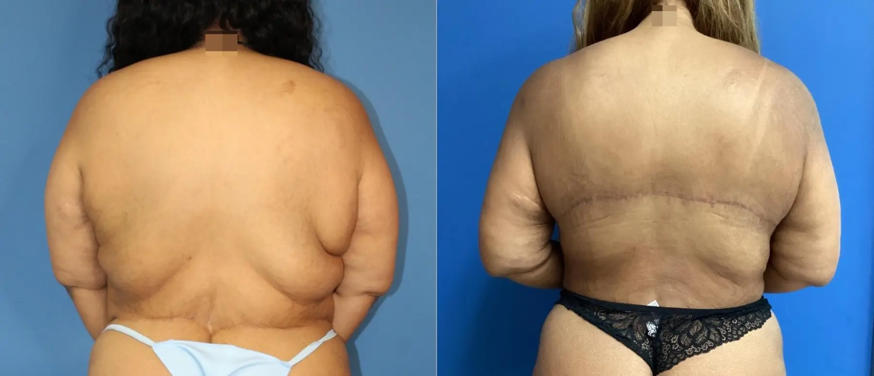 Back Lift: Patient 3 - Before and After  