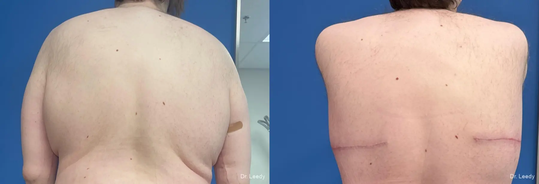 Back-lift-for-men: Patient 2 - Before and After  