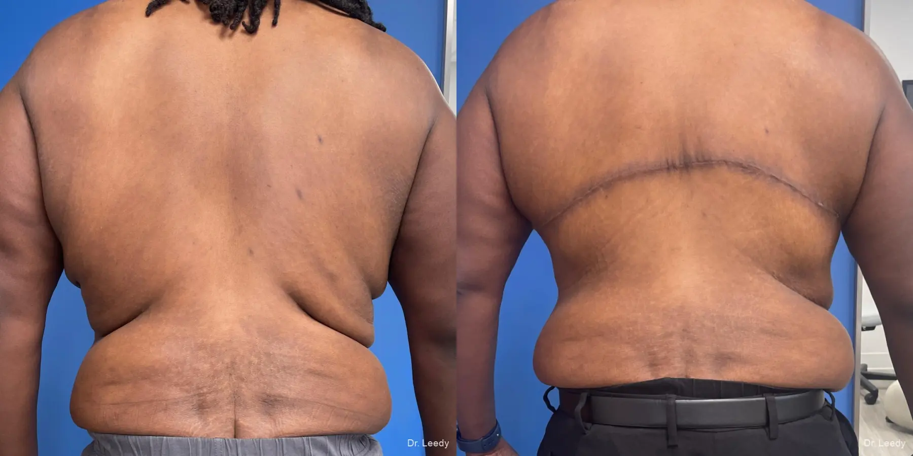 Back-lift-for-men: Patient 1 - Before and After  