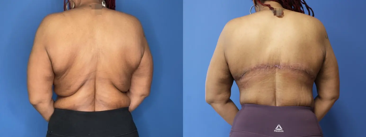 Back Lift: Patient 2 - Before and After  