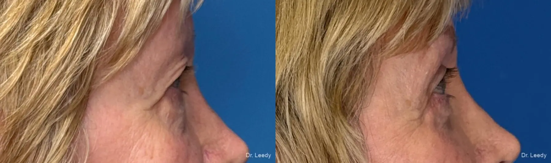 Blepharoplasty: Patient 6 - Before and After 3