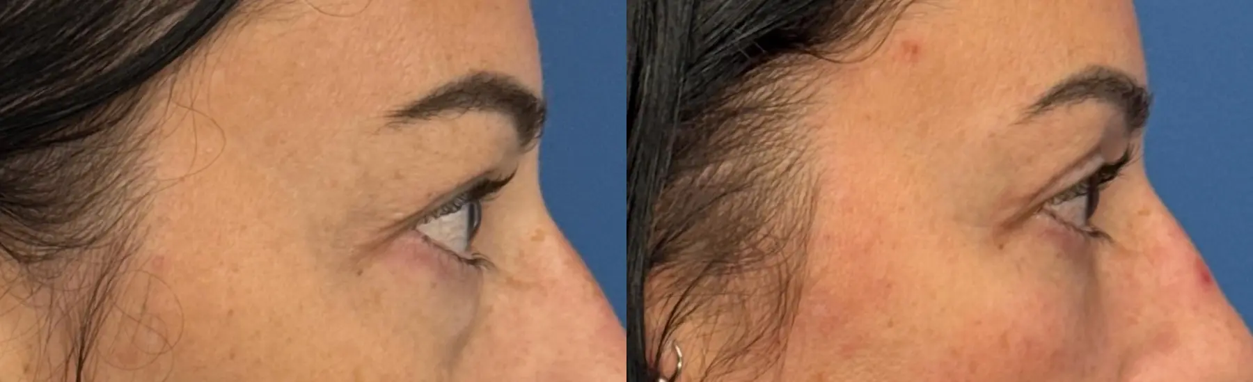 Blepharoplasty: Patient 5 - Before and After 3