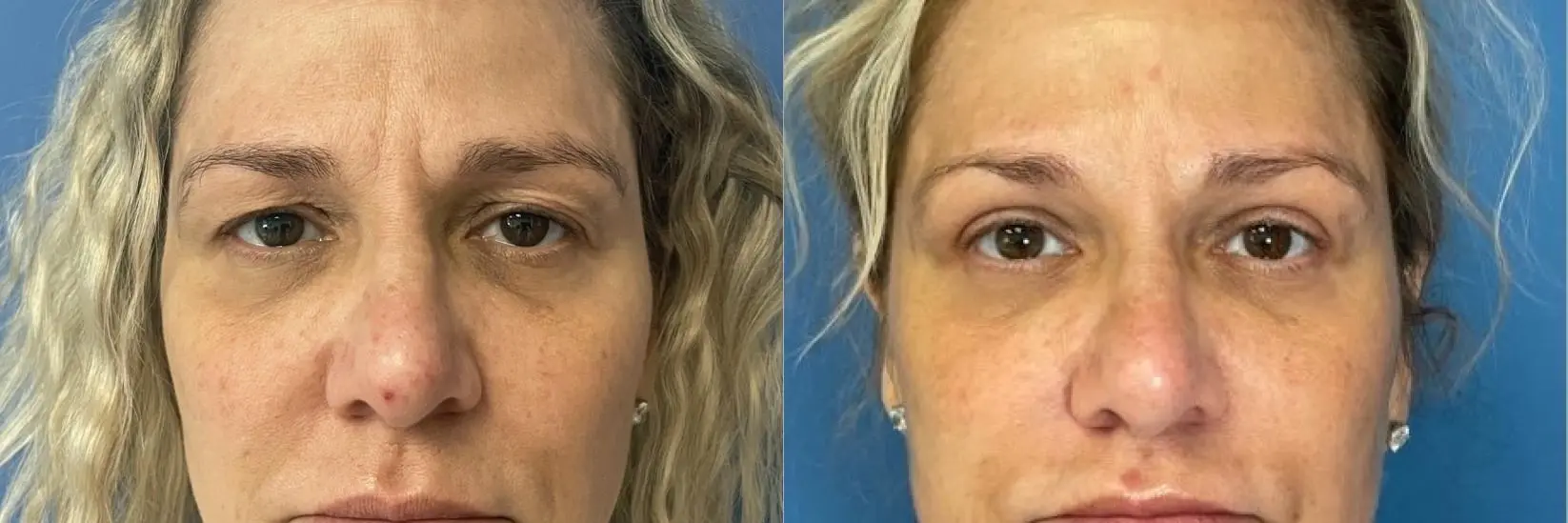 Blepharoplasty: Patient 1 - Before and After  