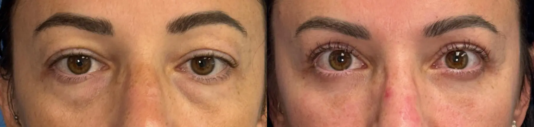 Blepharoplasty: Patient 5 - Before and After