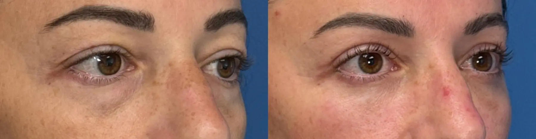 Blepharoplasty: Patient 5 - Before and After 2
