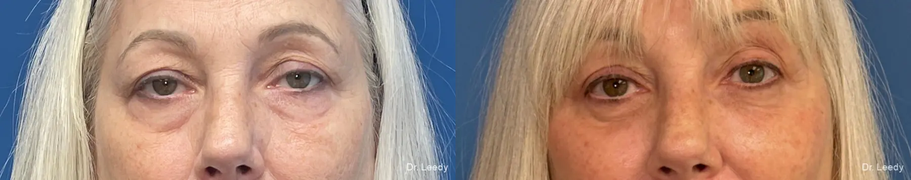 Blepharoplasty: Patient 2 - Before and After  