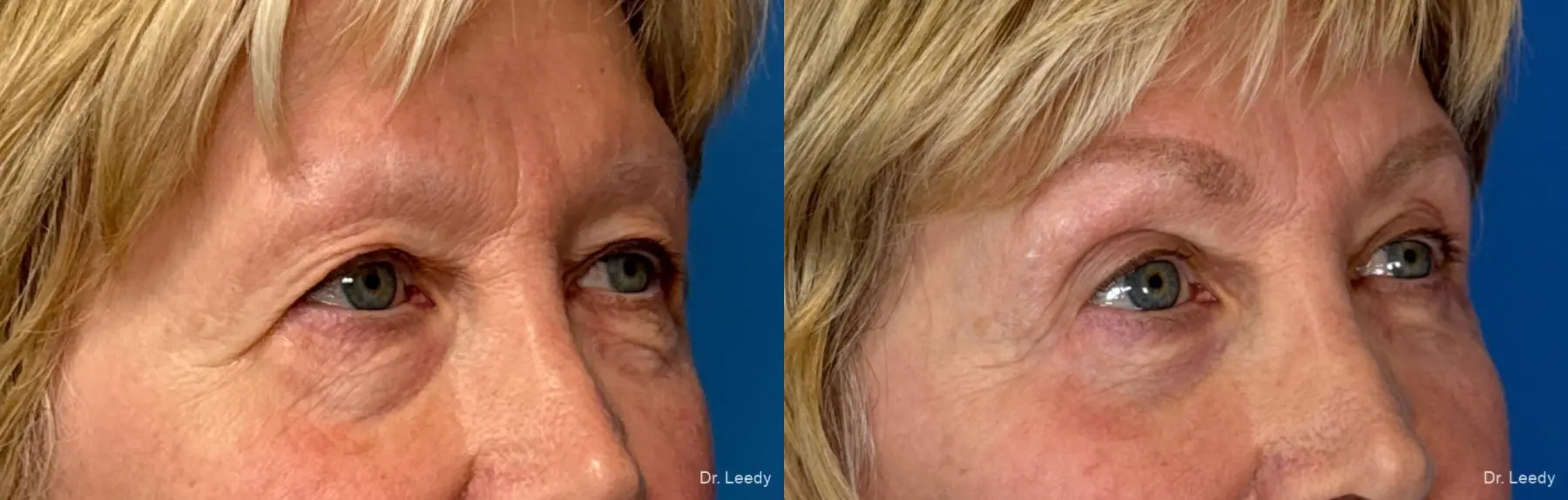 Blepharoplasty: Patient 6 - Before and After 2