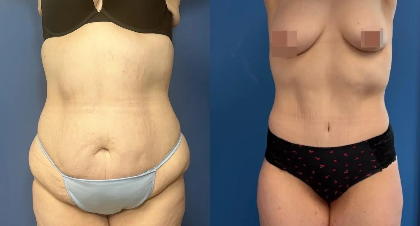 Body Contouring: Patient 1 - Before and After  