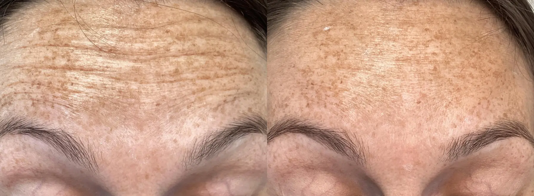 BOTOX® Cosmetic: Patient 5 - Before and After 2