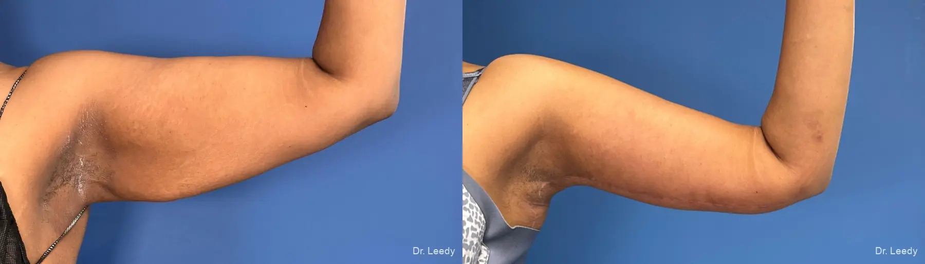 Brachioplasty: Patient 13 - Before and After  