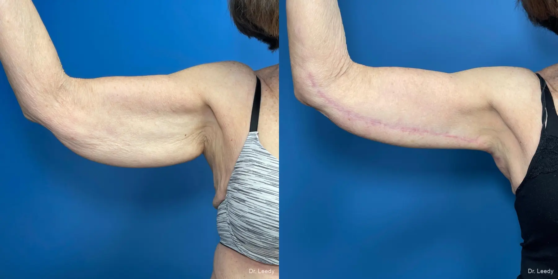 Brachioplasty: Patient 6 - Before and After  