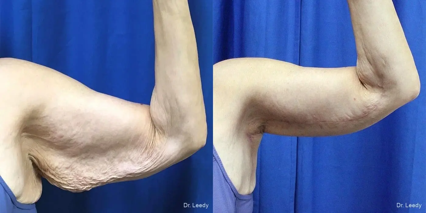 Brachioplasty: Patient 1 - Before and After  