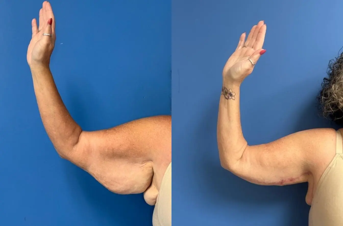 arm lift - Before and After