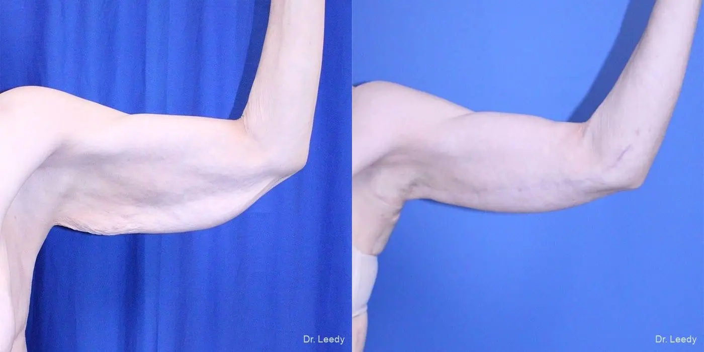 Brachioplasty: Patient 4 - Before and After  