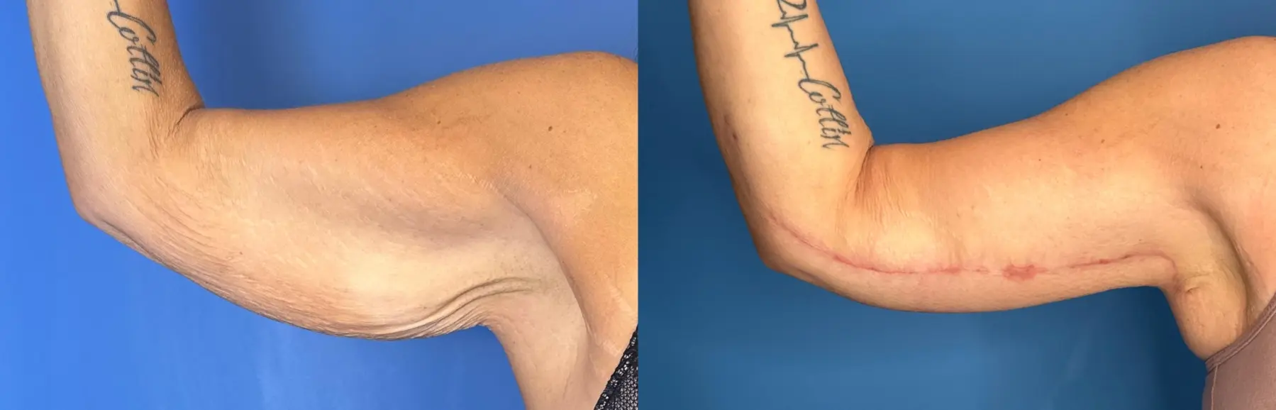 Brachioplasty: Patient 16 - Before and After  