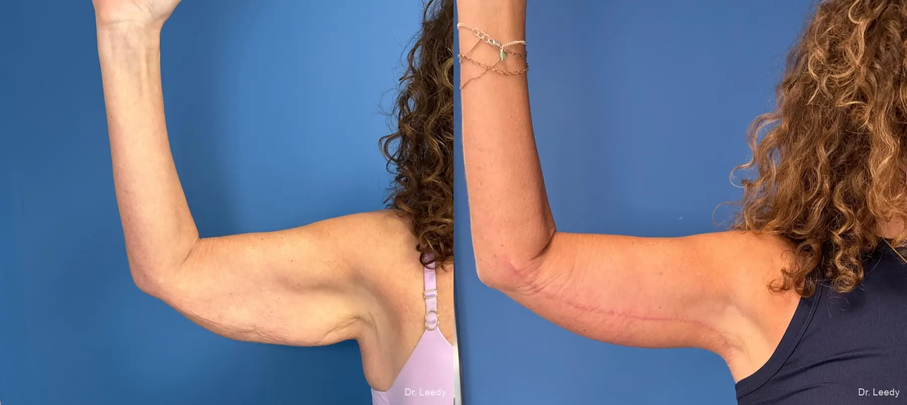 Brachioplasty: Patient 14 - Before and After  
