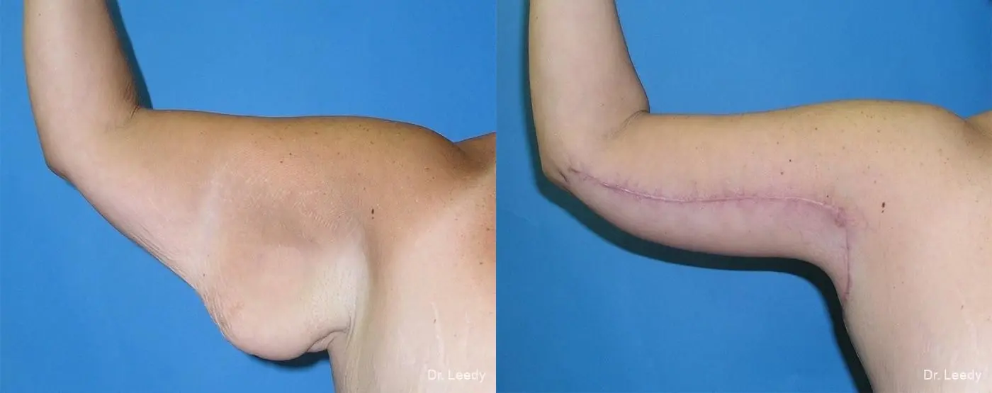 Brachioplasty: Patient 2 - Before and After  