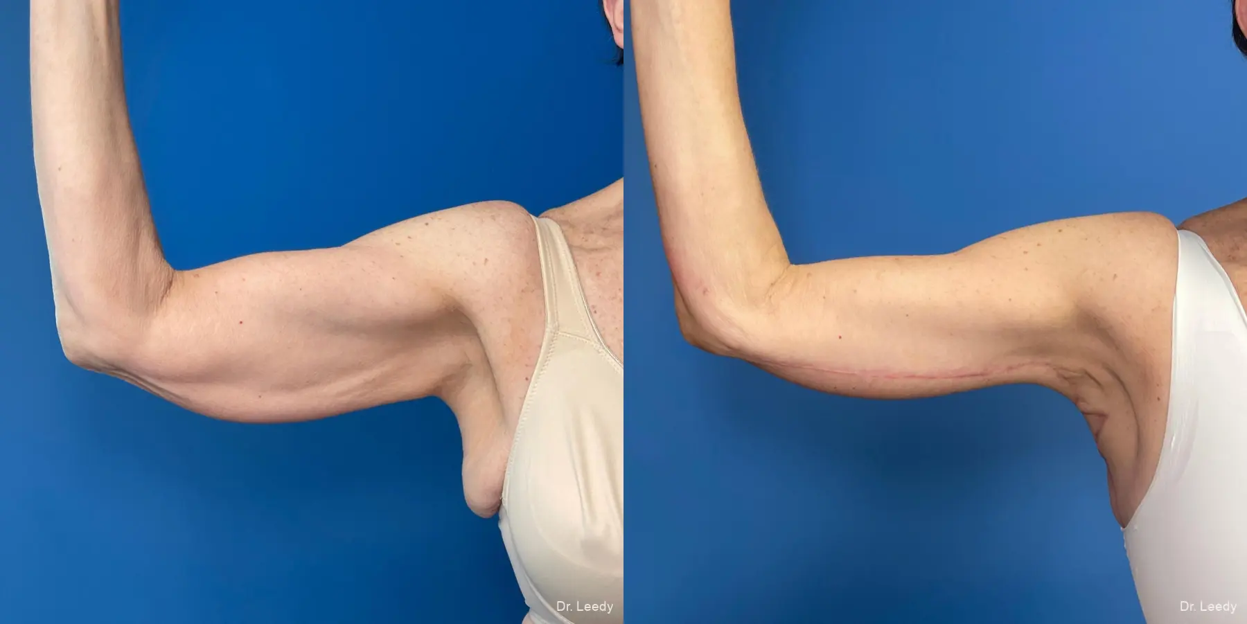 Brachioplasty: Patient 5 - Before and After  