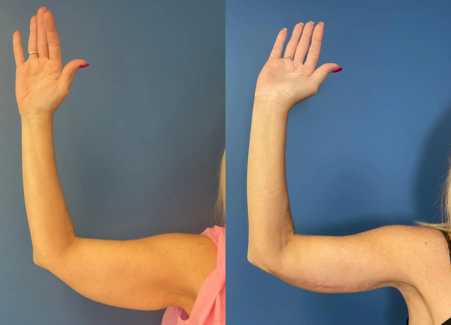 Brachioplasty: Patient 2 - Before and After  