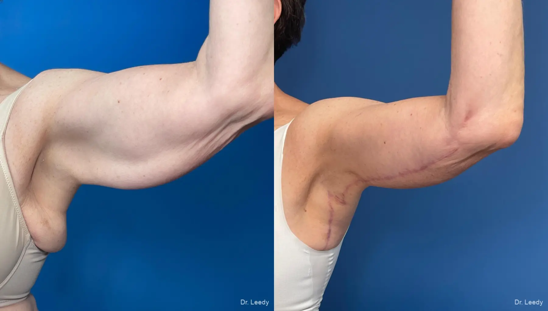 Brachioplasty: Patient 7 - Before and After  