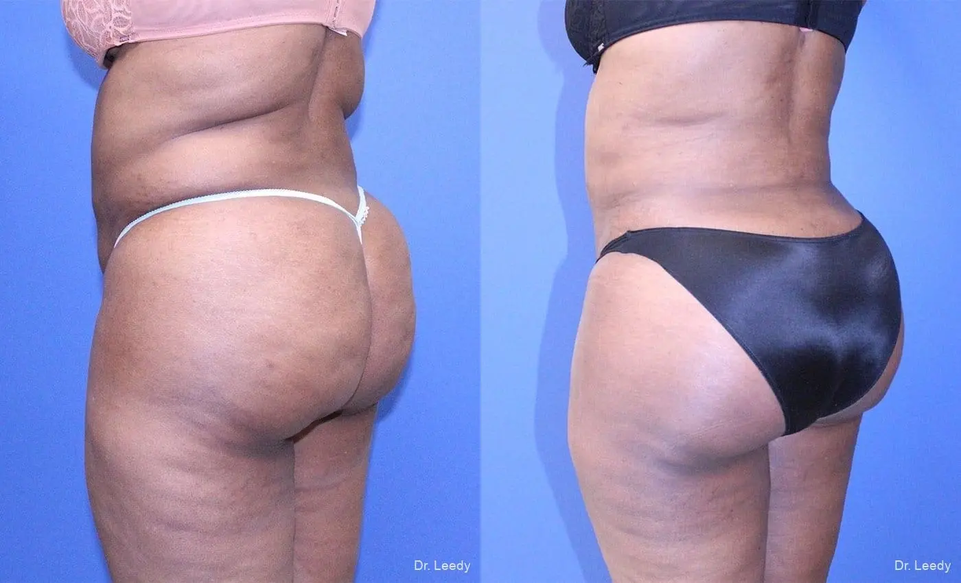 Brazilian Butt Lift: Patient 7 - Before and After 7