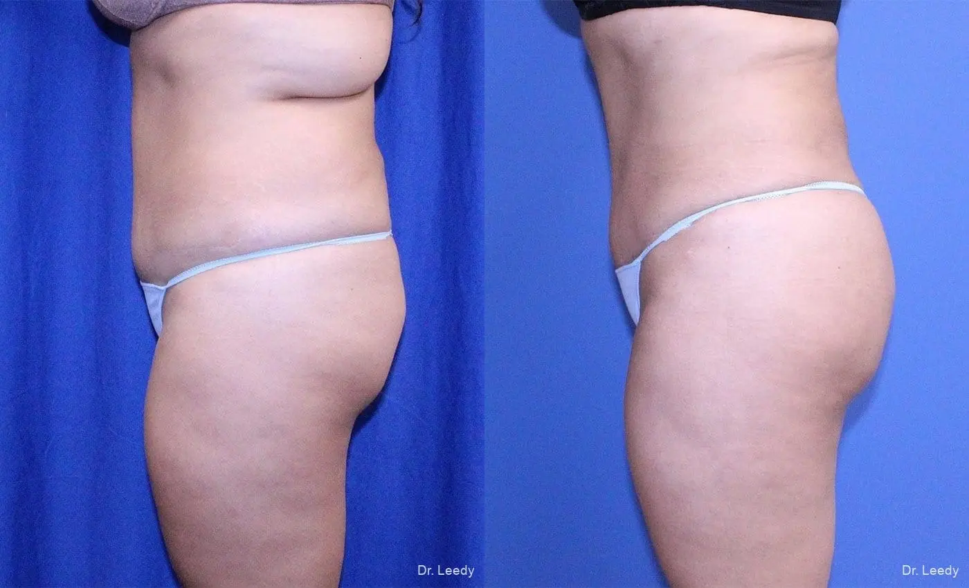 Brazilian Butt Lift: Patient 4 - Before and After 6