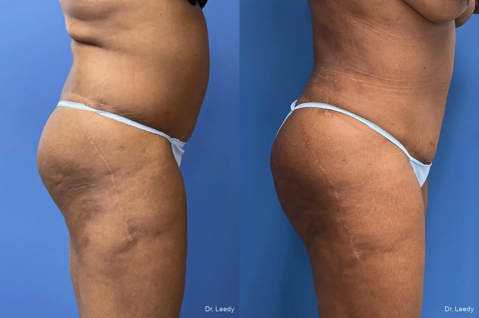 Brazilian Butt Lift: Patient 16 - Before and After  