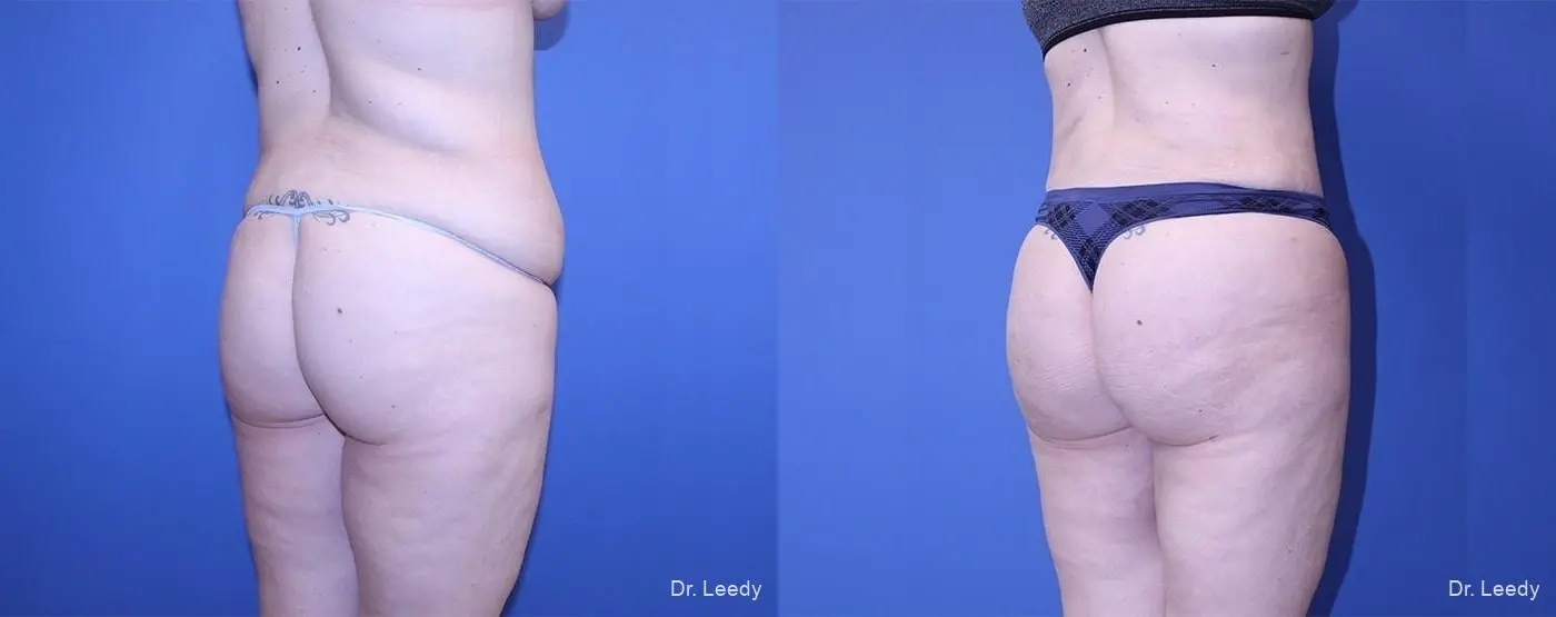 Brazilian Butt Lift: Patient 18 - Before and After  