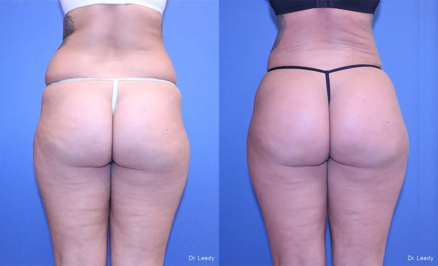 Brazilian Butt Lift: Patient 8 - Before and After  