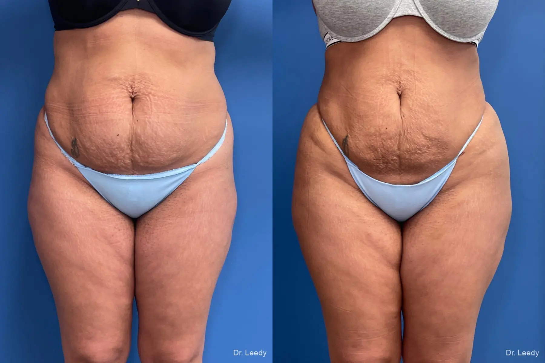 Brazilian Butt Lift: Patient 2 - Before and After 5