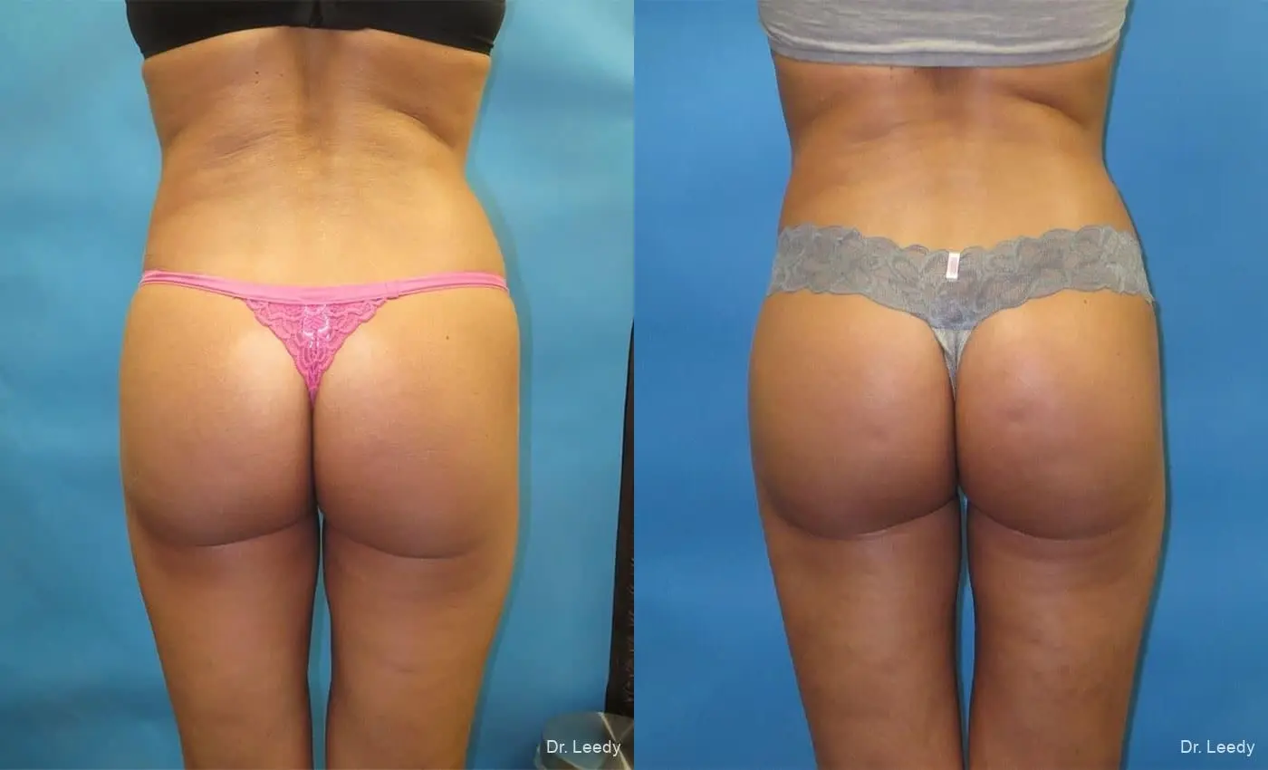 Brazilian Butt Lift: Patient 6 - Before and After 1
