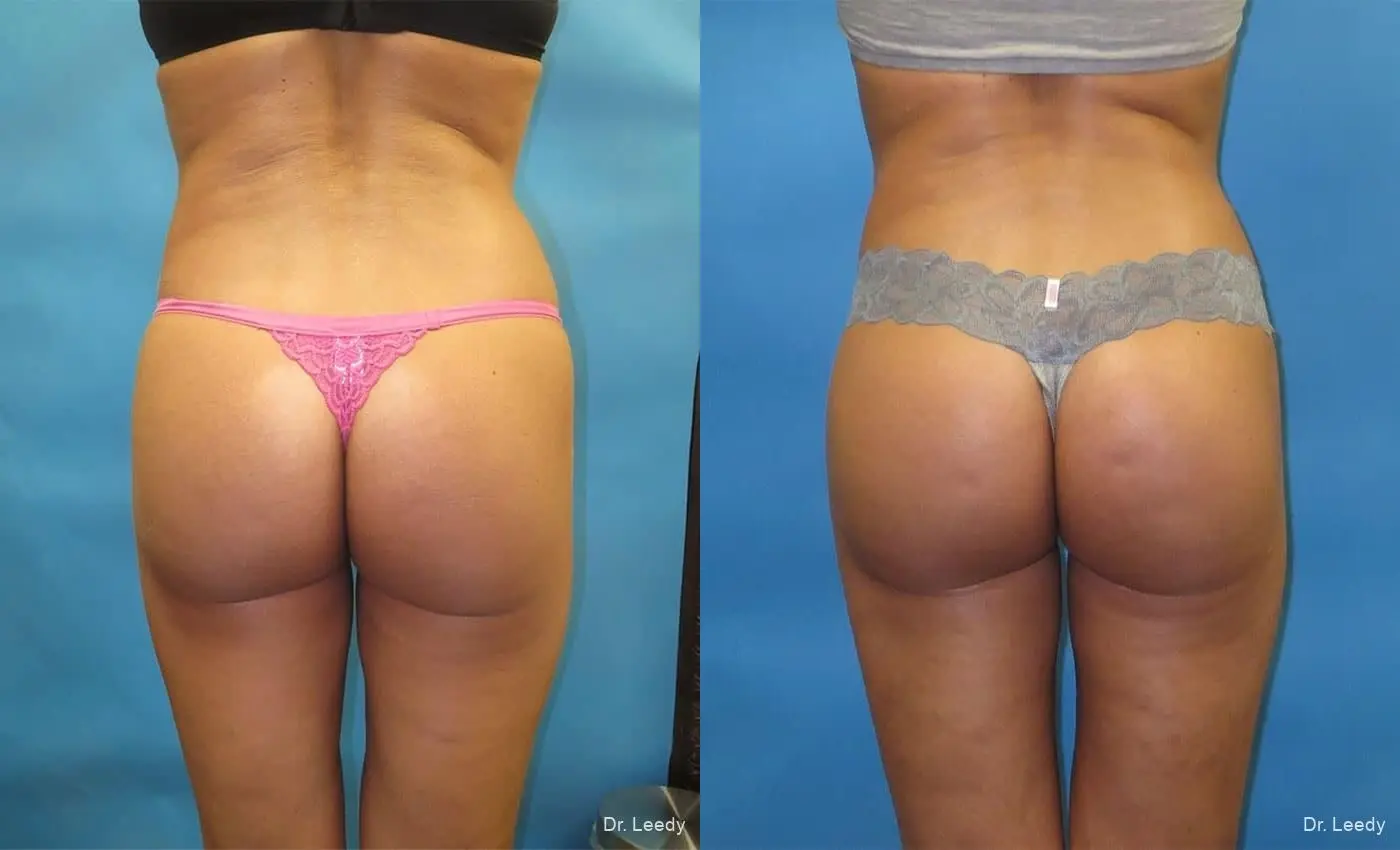 Brazilian Butt Lift: Patient 9 - Before and After  