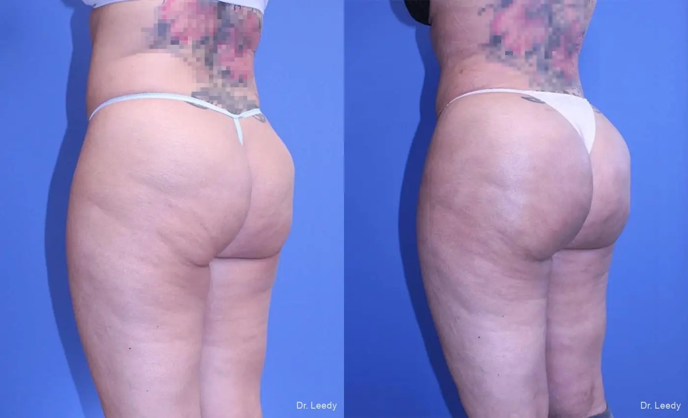 Brazilian Butt Lift: Patient 9 - Before and After 7