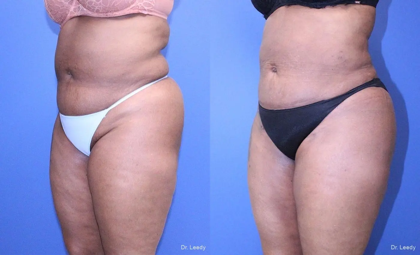 Brazilian Butt Lift: Patient 7 - Before and After 6