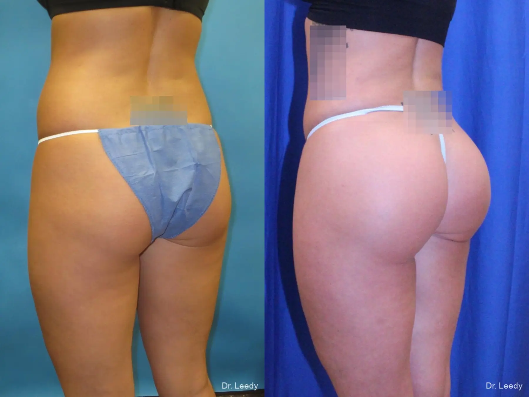 Brazilian Butt Lift: Patient 1 - Before and After  
