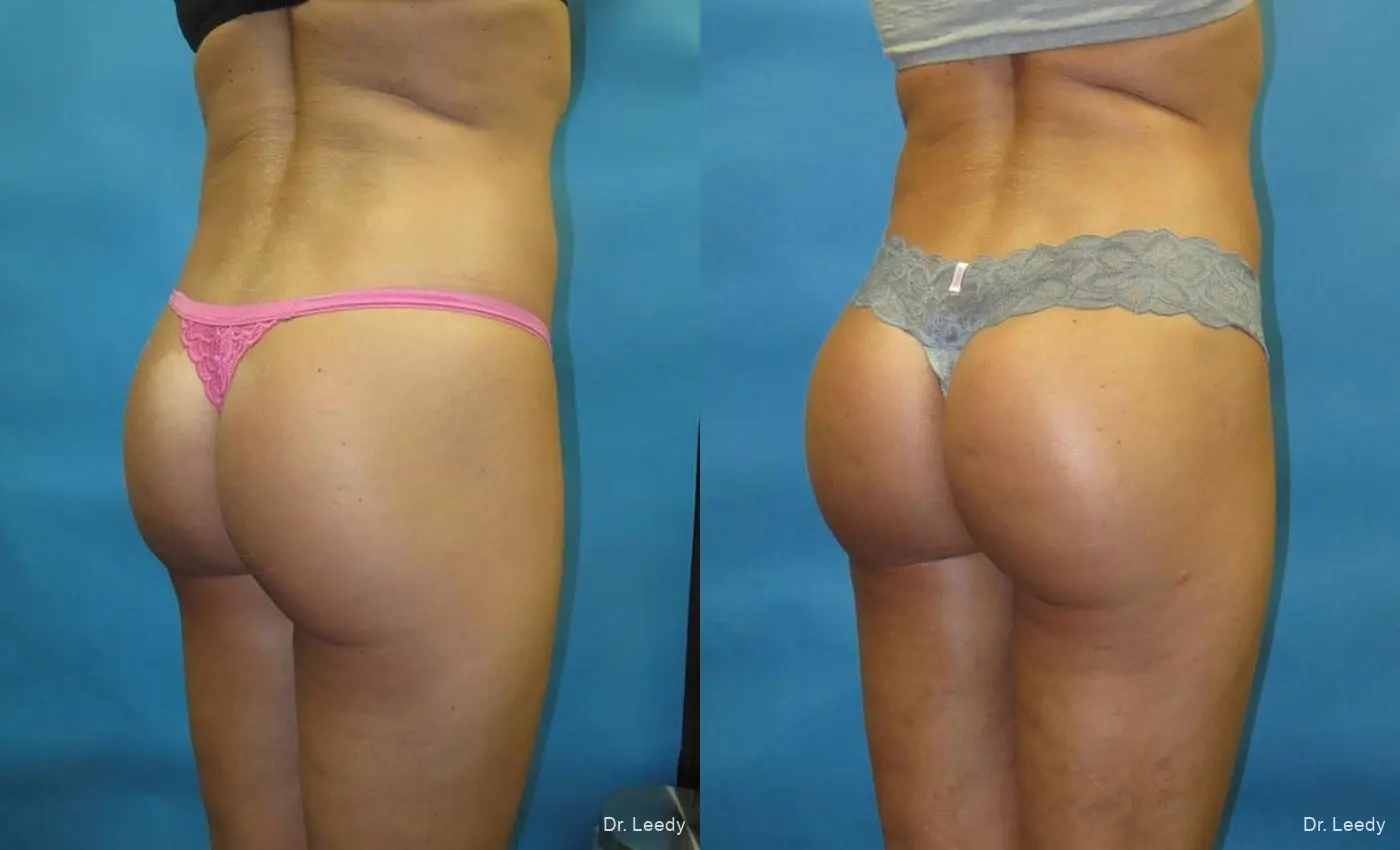 Brazilian Butt Lift: Patient 6 - Before and After 4
