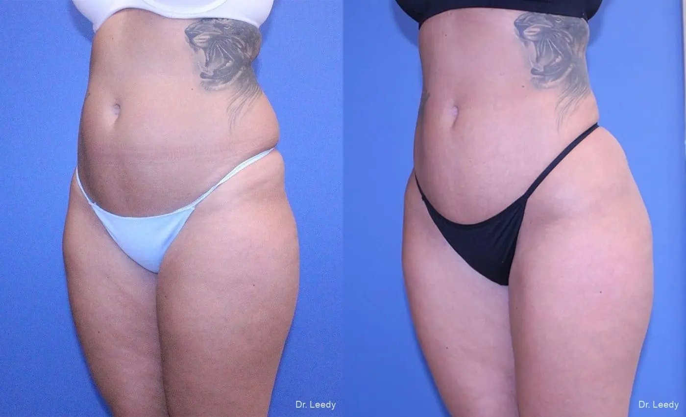 Brazilian Butt Lift: Patient 8 - Before and After 6