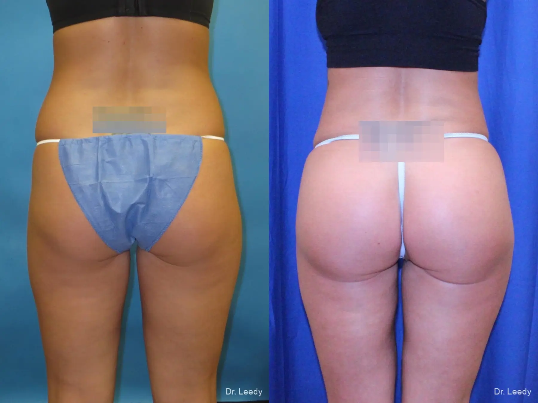 Brazilian Butt Lift: Patient 1 - Before and After 2