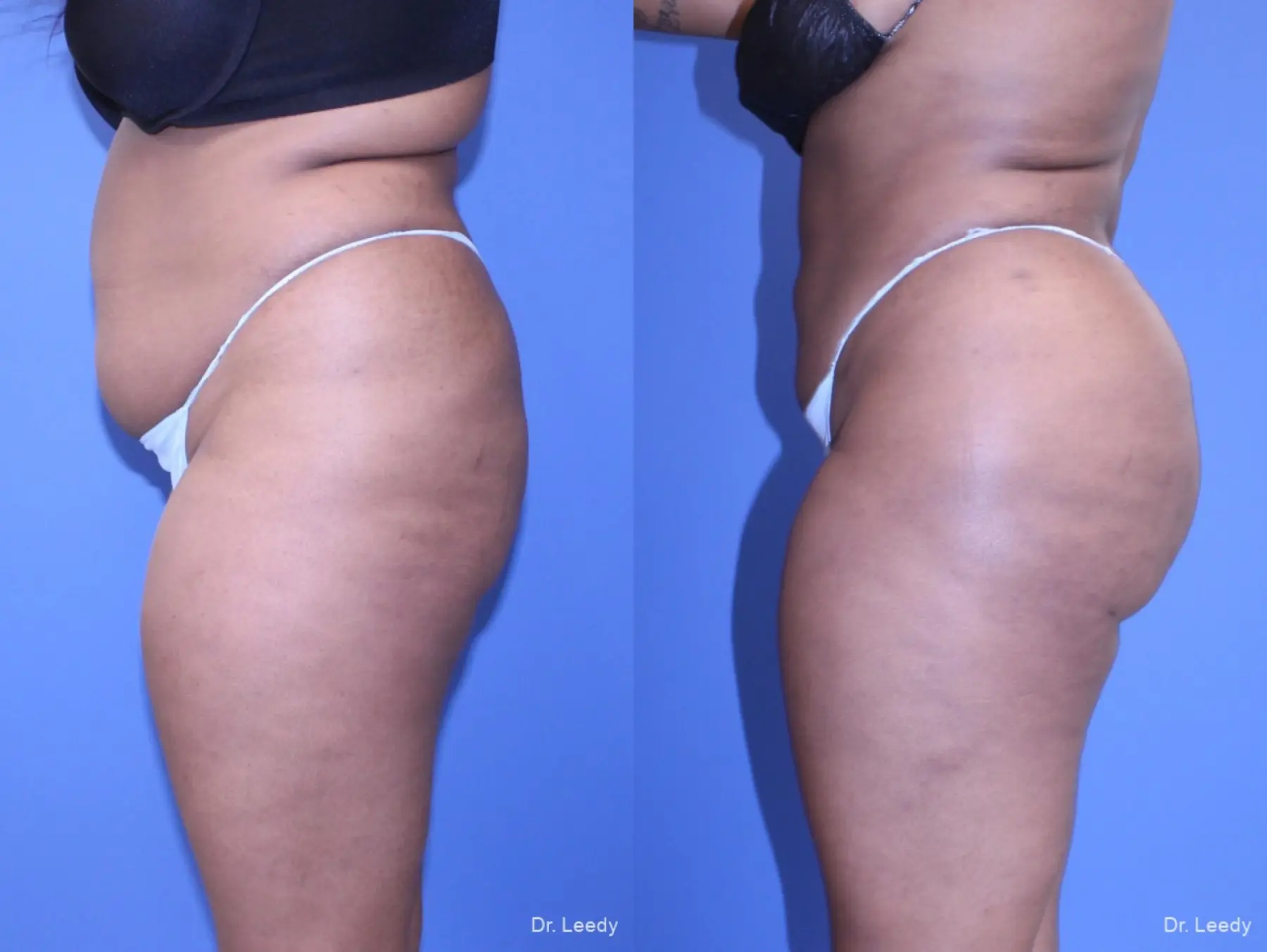 Brazilian Butt Lift: Patient 5 - Before and After 3