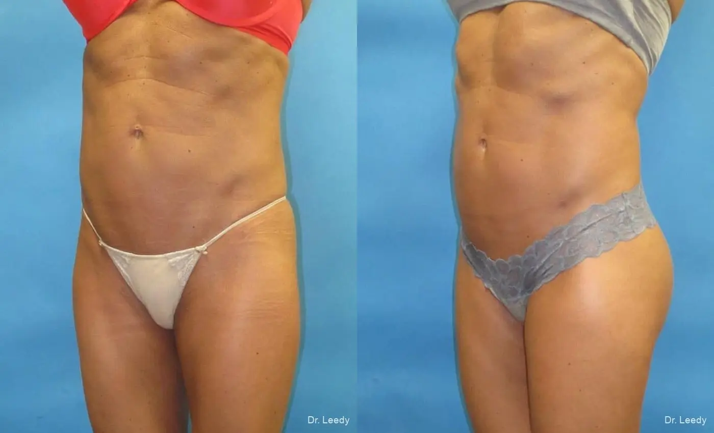 Brazilian Butt Lift: Patient 6 - Before and After 6