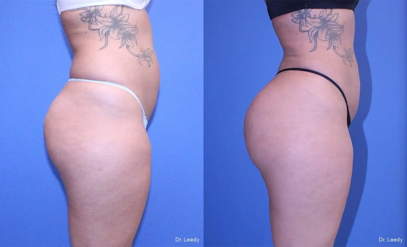 Brazilian Butt Lift: Patient 7 - Before and After 5