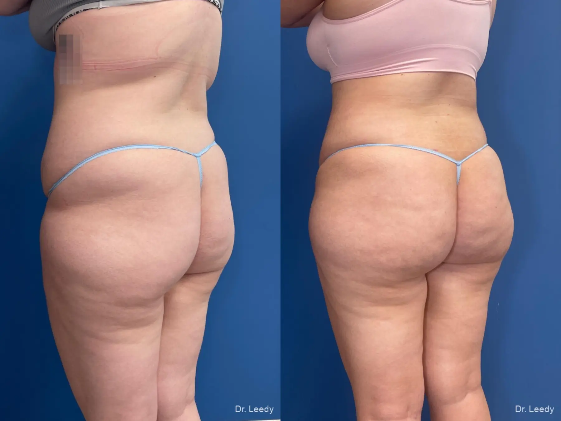 Brazilian Butt Lift: Patient 15 - Before and After  